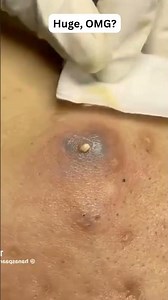 Large Blackheads Extraction Big Cystic Acne Blackheads&Whiteheads Removal Pimple Popping #1132 2026