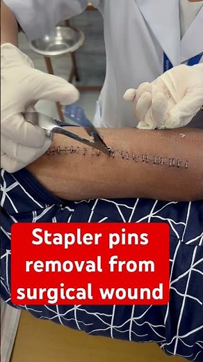 Multiple ways to close a surgical wound 1) nylon sutures 2) skin staplers 3) dermabond #woundcare