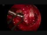 Sinus Tumor: Sarcoma in the Pterygopalatine Fossa (4K) • Video • MEDtube.net