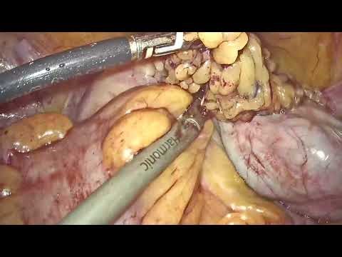 Pan Hysterectomy for Recurrent Ovarian and Bowel Endometriosis.