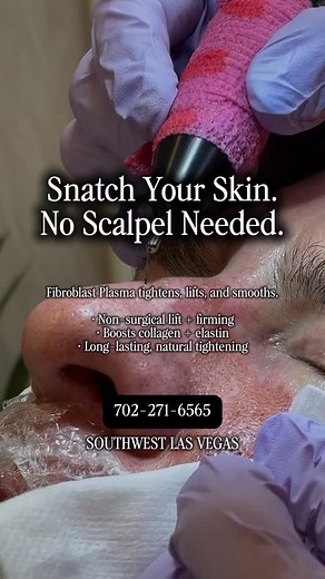 ✨ The Future of Anti-Aging is Plasma ✨ If you could gain five to ten years back on your face in just a few days… without surgery — would you? That’s what Fibroblast Plasma Lift delivers. It uses advanced plasma energy to activate your fibroblast cells, rebuilding collagen and elastin for a tighter, smoother, more lifted look. No cutting. No fillers. Just your own skin—renewed, reawakened, and radiating youth. Because the future of anti-aging isn’t surgery… it’s science. 💫 📍 Skin Rehab Lab | La