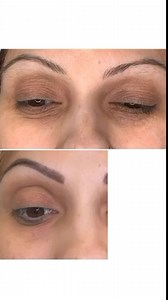 ⚠ PARPADOS CAIDOS? BLEFAROPLASTIA SIN CIRUGÍA con MORPHEUS 8 SOLO...