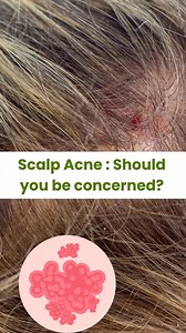 Scalp Acne : Should you be concerned? #Scalpcare #scalpacne #thshealth #scalpacnetreatment Disclaimer - The video is meant for informational purpose. It is not intended to be a substitute for professional medical advice diagnosis or treatment. Contact a physician if you have a medical condition | Thehealthsite.com | Facebook