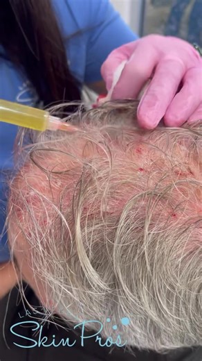 🩸 PRP Hair Injection 🩸 Benefits: 💉 Promotes hair growth 💉 Rejuvenates hair 💉 Long lasting results 💉 Stimulates collagen production Call 702-940-9925 for more info!!! #PRP #injections #hairloss #rejuvenate #collagen #medspa #spa #lasvegas #lasvegasskinpros #drstile #stileaesthetics #longlastingresults #results #hairgrowth | Dr. Stile