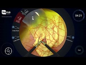 How to perform a cholecystectomy