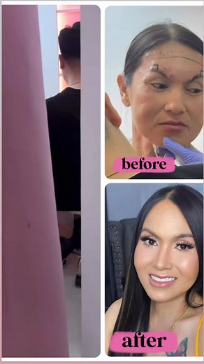 😳 3 weeks after PROFHILO/ Face Fillers/ Barbie forehead/ chin/ lips /cheeks/ Botox and Everything (Done by Licensed Doctor 🧑‍⚕️) . Malabon Branch: 🚩 Waze, Google Map, Grab Keyword: 🚖 The Fairygodbarbie (Malabon Branch) Address: 41 M. H. Del Pilar, Malabon City Phone: (02) 7915 2675 Viber: (0954) 174 8544 Timog Branch: 🚩 Waze, Google Map, Grab 🚖 The Fairygodbarbie (Timog Branch) Phone: (02) 8725-1237 Viber: 639153507007 Malate Branch: 🚩 Waze, Google Map, Grab 🚖 The Fairygodbarbie (Malate 