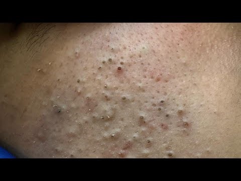 [ASMR] Satisfying Blackhead and Whitehead Extraction for Clearer Skin