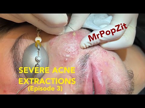 Severe Acne Extractions episode 3. The final episode, part 3 of 3. Giant waxy plugs removed.