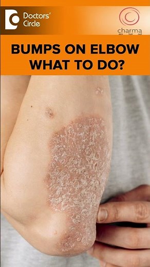 Bumps on Elbow - Causes, Symptoms & Treatment - Dr. Rajdeep Mysore | Doctors' Circle #shorts