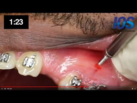 Placement of orthodontic mini implant Temporary Anchorage Device TADs Infinity IOS