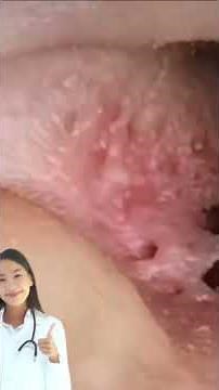 Monster Blackhead In Ear #pimple #removal #blackheads #earcare