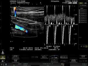 鎖骨下動脈の収縮期最大血流速度 PSV(Peak Systolic Velocity)