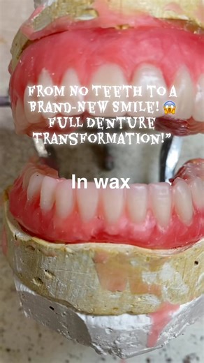 #DentureMakeover #NewSmileJourney #DentalLabLife #BeforeAndAfterSmile #HandcraftedDentures | JOs Dentures Lab
