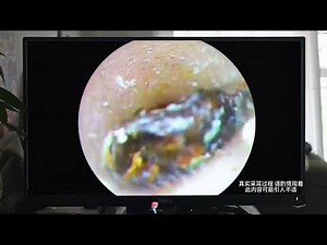 Deep Ear Cleaning Procedure — Insanely Satisfying Ear Wax Removal