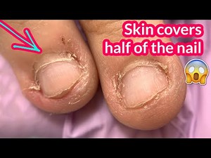 Skin Covering the Nail 😲 Bitten Nails Transformation | Acrylic Brush by Modelones