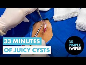 33 Minutes of Juicy Cysts