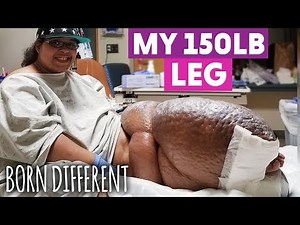 The Woman With The 150lb Leg | BORN DIFFERENT