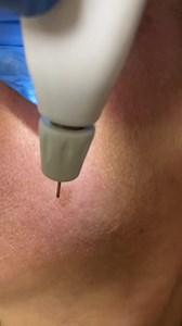 Ready for the magic ??? Removing all kind of skin imperfections #pigmentations #melasma#brownspots#tiredskin#flawless #lunchbreak#procedure#cleaning#perfectskin#skincare | Carole Zamroud - Z. Clinic Beirut/Dubai