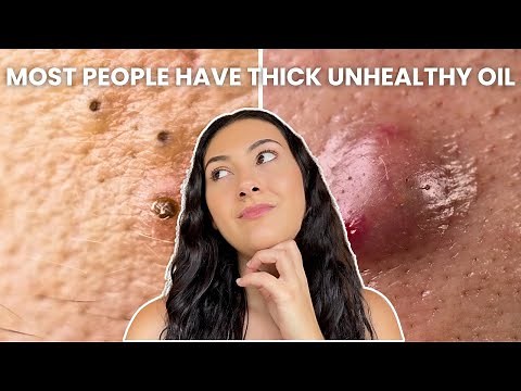 How To Treat Every Type of Acne (Comedones, Nodules, Cysts)