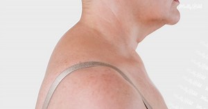 Fast fix for “Neck Hump”