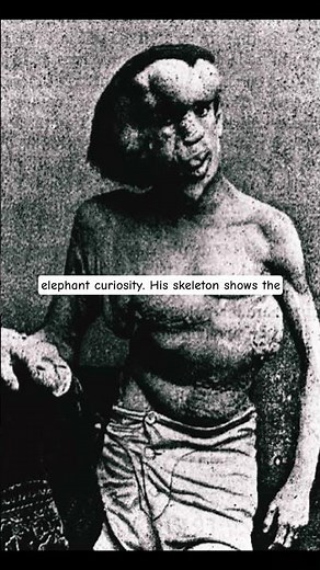 Joseph Merrick: The Elephant Man and His Extraordinary Life 🧠🕯️