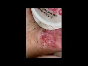 Multiple BlackHeads Extracted (BLEACKHEADS Removal Videos 2022) / #10