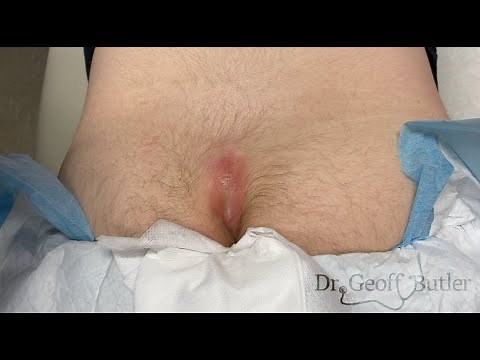 Drainage of an infected pilonidal cyst - GRAPHIC CONTENT