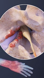 If the spinal cord becomes compressed within the cervical spine pain or neurological deficits may be experienced in the arms, leges, or anywhere below the level of compression. Do you experience pain in these areas? | Spine-health