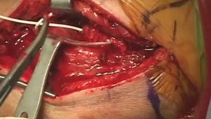 ORIF of the Proximal Humerus Through an Anterolateral Acromial Approach