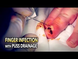 FINGER INFECTION with PUS DRAINAGE (in slow motion) | Dr. Paul