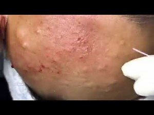SUPER Removal of Cyst, Acne on the Forehead at HIỀN VÂN SPA - Part 3 # TRỊ MỤN HIỆU