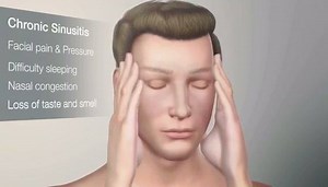 This animation shows the PROPEL sinus stent in action. Opens the sinus cavity, delivers medication to the healing tissue and maintains the outcomes of sinus surgery. •••••••••• 🎥 Watch Part 1 ☎️ Call us to schedule your consultation at: (201) 408-5430. 📩 Email for more info: info@drmonicatadros.com 🌐 Visit our website: Link in bio!. •••••••••• #facialplasticsurgeon #facialplasticsurgery #plasticsurgey #radiesse #drtadros #plasticsurgeon #surgeon #botox #restylane #nosejob #rhinoplasty #otopla