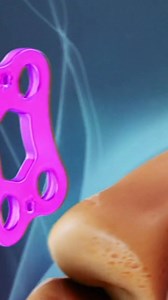 69K views · 389 reactions | Need to understand how bone fusion healing works after surgery or injury? This video breaks down the stages of spinal fusion recovery, bone graft healing, and what to expect during the bone fusion process. | Spine-health | Facebook