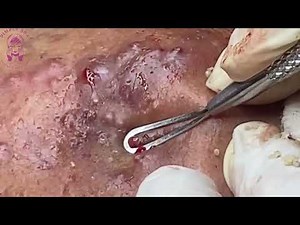 PUS ACNE TREATMENT & Pimple Blackhead Extraction