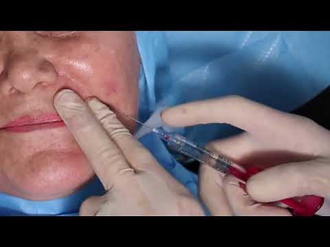 Basic nasolabial fillers with cannula