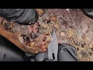 Histopathology of Severe Jigger Infected Person in 2025