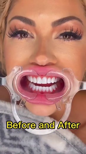 12K views · 20 comments | Smile confidently and naturally. Our composite resin gives you a flawless and long-lasting smile. Discover its power now! | Dental Design Smile | Facebook