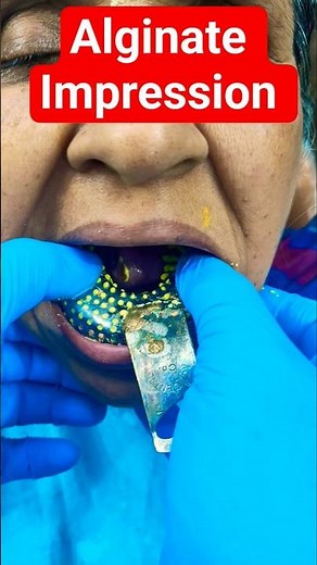 #Alginate Impression #Impression of Lower Jaw #Lower jaw impression with Alginate