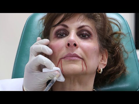 Treating Facial Lines: Juvederm XC Filler w/ Dr. Sohel Islam at Advanced Specialty Care