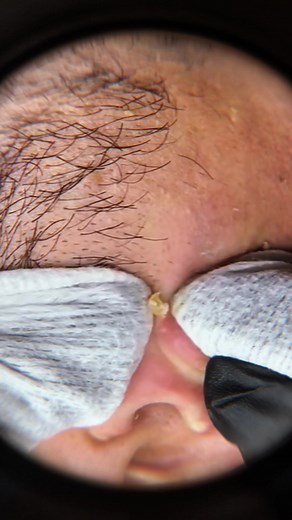 Incredible Blackhead Extraction Videos