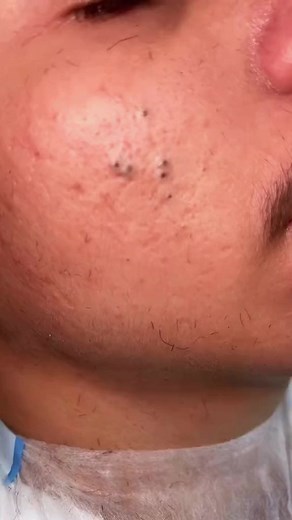 Satisfying Blackhead & Pimple Removal | OMG!