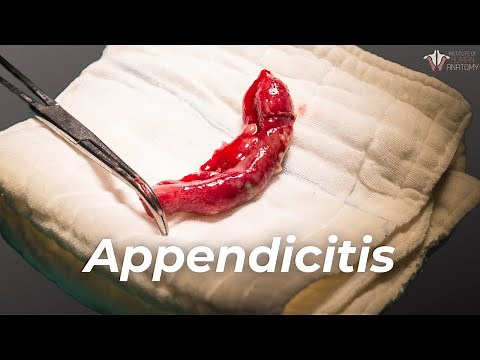 What Causes Appendicitis & How to Treat It