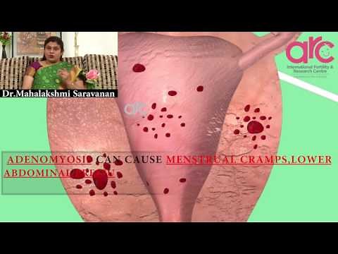Adenomyosis uterus- Risk Factors, Symptoms, Diagnosis, signs & treatments @ ARC Fertility Hospitals
