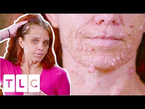Dr. Lee Helps Woman Covered In Cysts I Dr. Pimple Popper