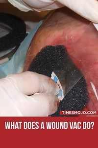 What does a wound vac do? - TimesMojo