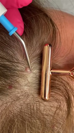 Cherry Angiomas Removal #shorts