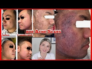 THE BEST Acne Scar Treatment - INCREDIBLE iPixel Laser Skin Resurfacing before and after (2023)