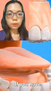 3K views · 20 reactions | Gingival Hyperplasia is having overgrowth of Gingiva. #irumadentalclinic #docanneirumalinto #fbreelsfypシ゚viralfbreelsfypシ゚viral #fbreelsfypシ゚viralシ #fbreelsfypシ゚ #dentalknowledge #OralHealth #gingiva #gums #gumsurgery #gumovergrowth #dentalcare #dental #DentalHealth #oralsurgery #oralhygiene #oralcare | Iruma Dental Clinic | Facebook