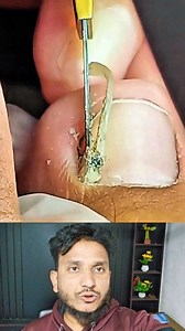 951K views · 2.4K reactions | How Doctors fix infected toenails step #Toenailtreatment #health #usa #reelsviralシ | Md Alamgir Hasan | Facebook