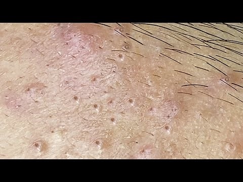 Acne Treatment With Sac Dep Spa #05